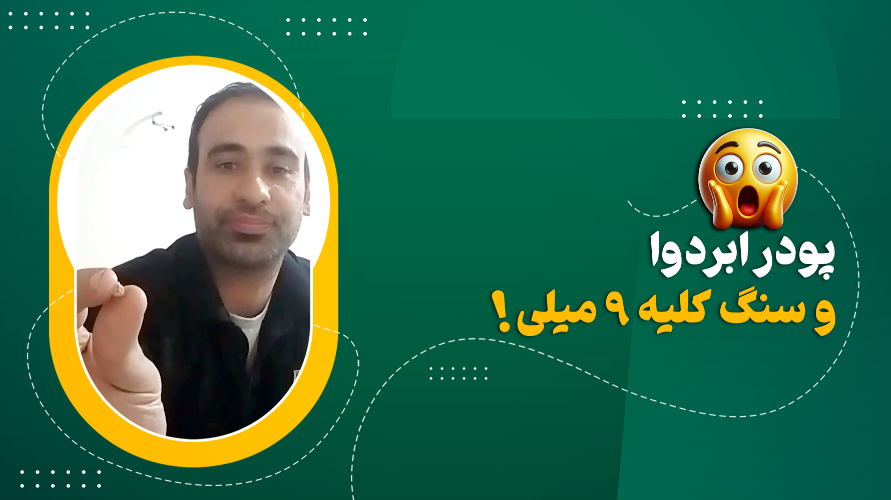 بلایی که پودر ابردوا سر سنگ کلیه میاره😲
